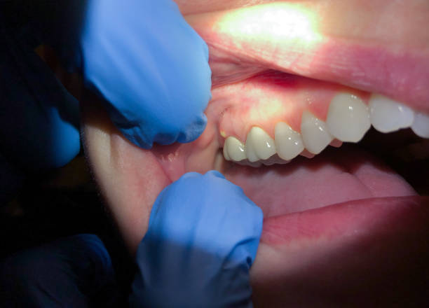 Best Emergency Cosmetic Dentistry (e.g., broken veneers) in Fairwood, WA