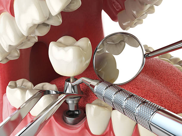 Best Emergency Root Canal Therapy in Fairwood, WA